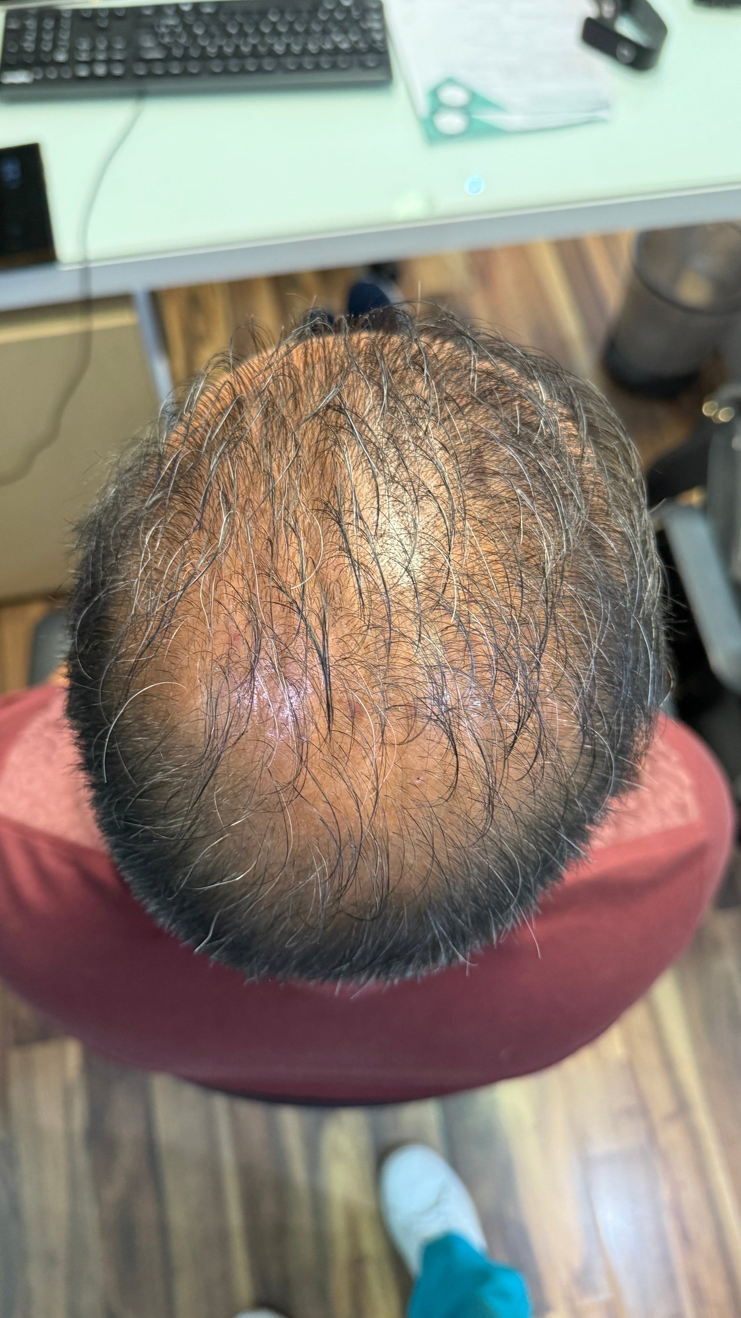 Alopecia conoce las principales tipos