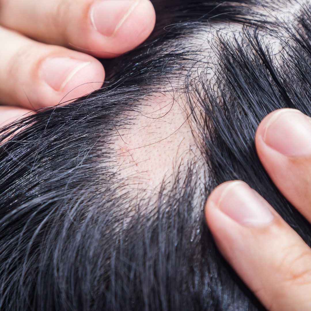 ALOPECIA