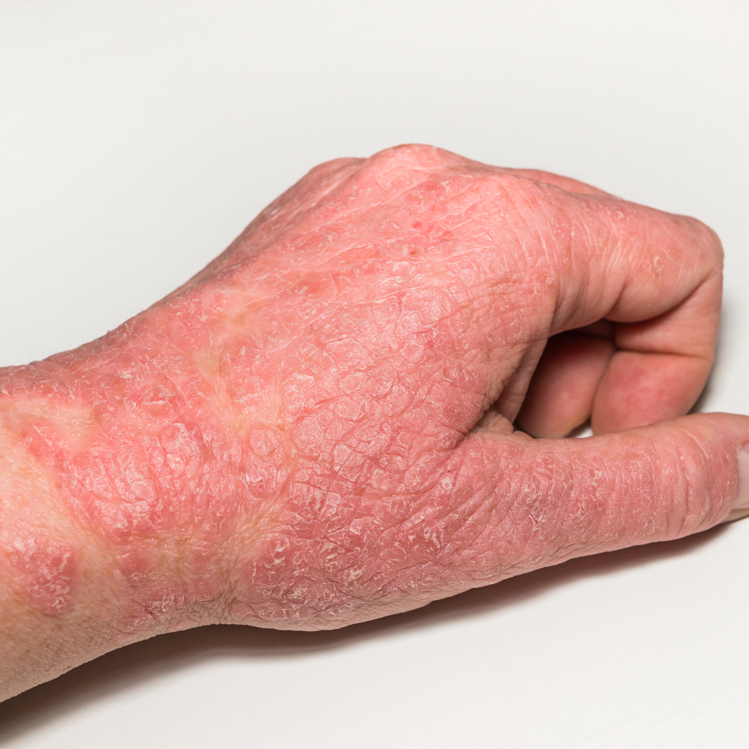 DERMATITIS ATÓPICA