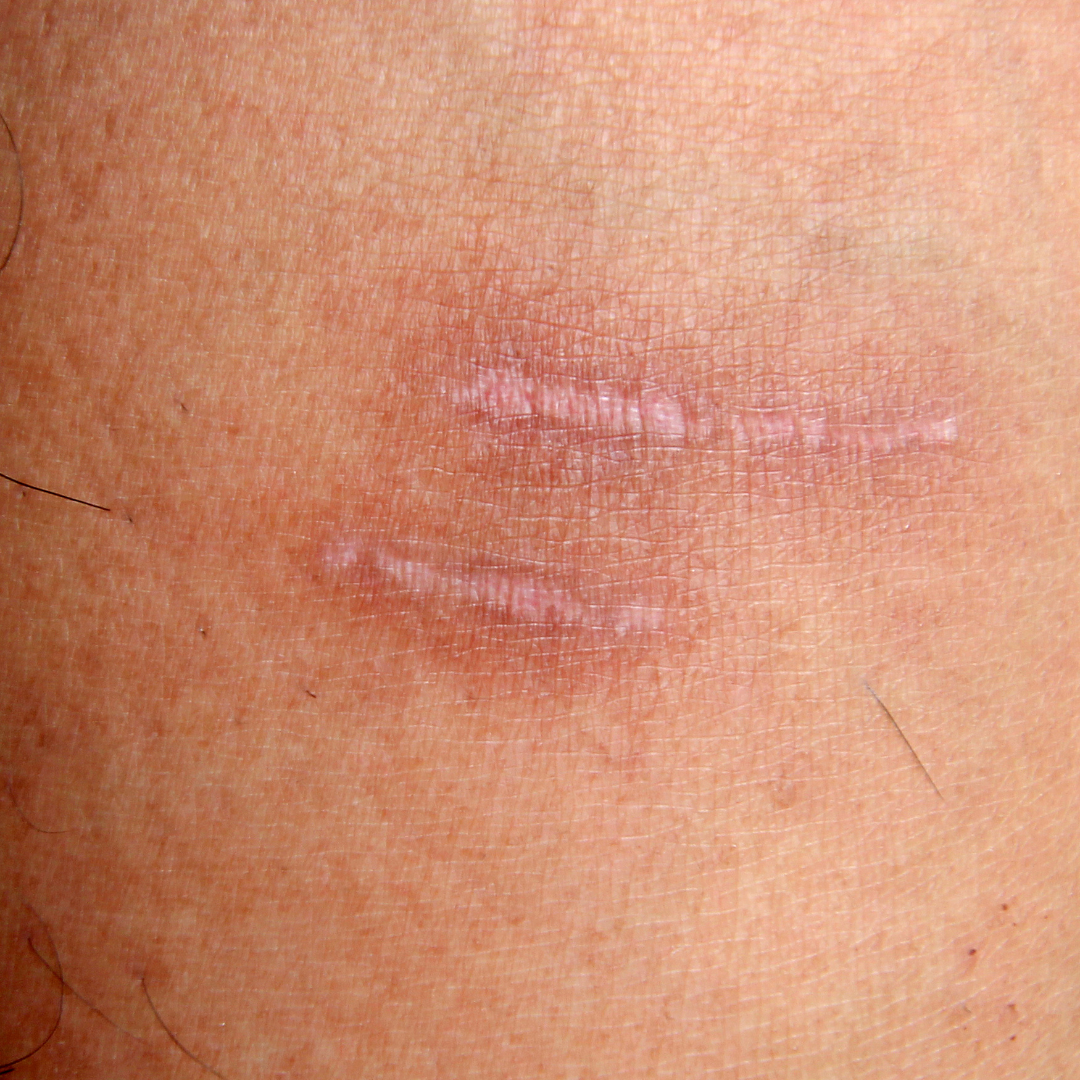 CICATRIZ